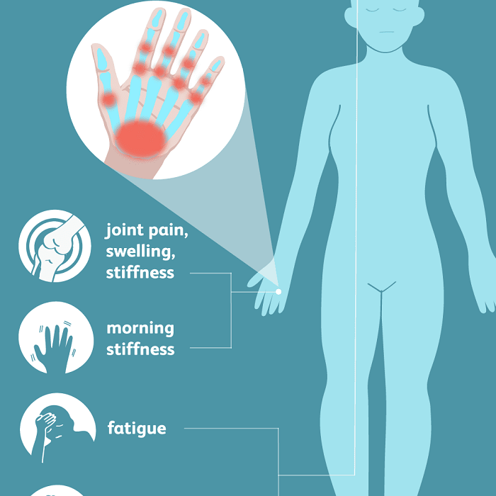 Arthritis Symptoms and treatment | Ayurveda 